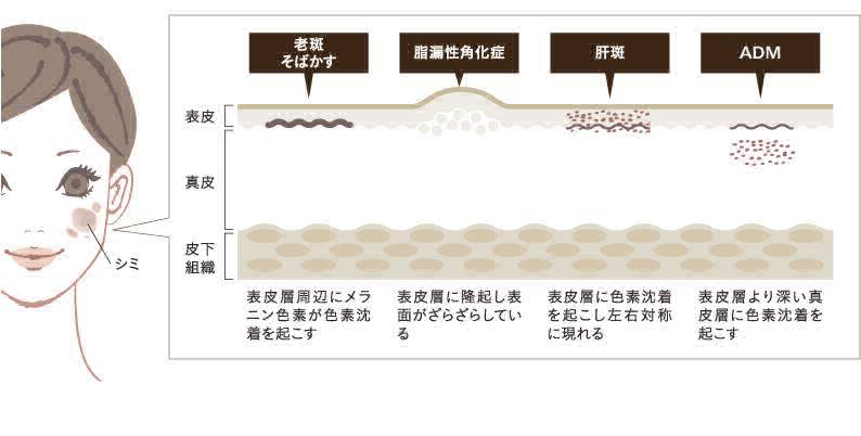 シミの種類